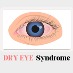 Dry Eye Syndrome