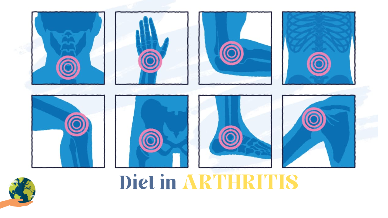 Diet In Arthritis: गठिया में क्या खाना चाहिए और क्या नहीं